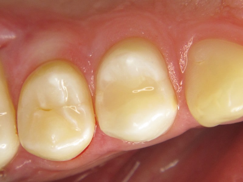 Composite Fillings-3 | Astra Dental Centre