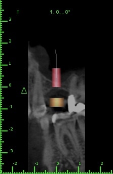 Implant_View | Astra Dental Centre