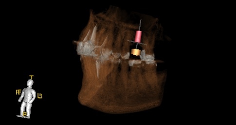 implant_planning | Astra Dental Centre