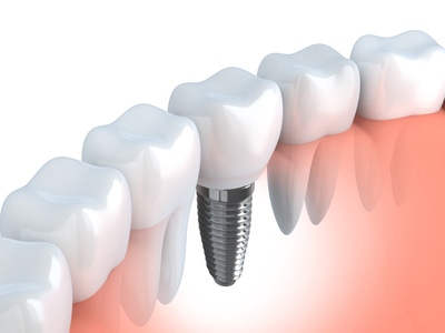 Dental implant | Astra Dental Centre