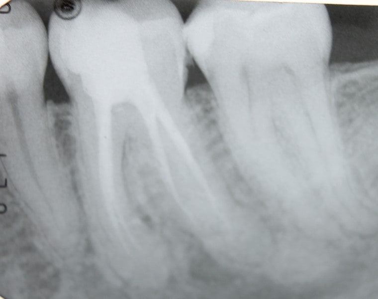 root canal xray-2 | Astra Dental Centre